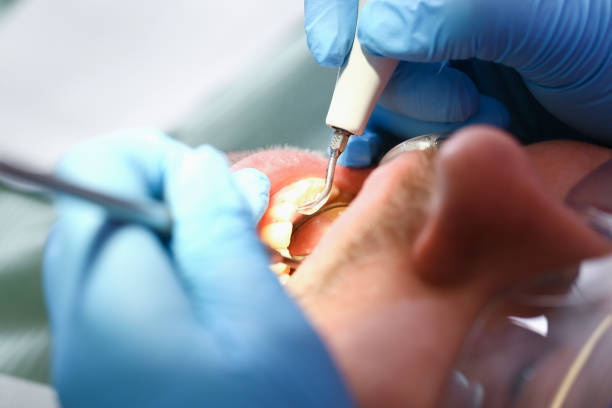 Best Emergency Wisdom Tooth Extraction in North Miami, FL